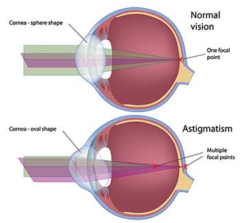 Astigmatism Treatment in Chesterfield