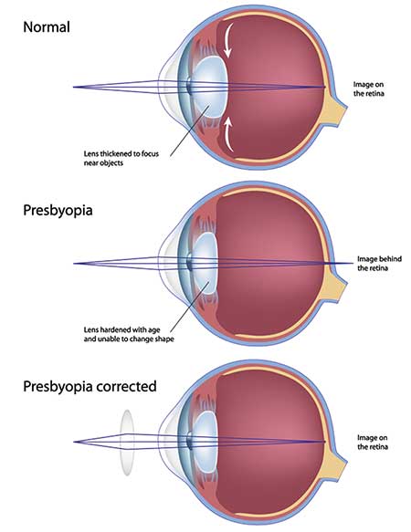 Presbyopia Doctor in Chesterfield