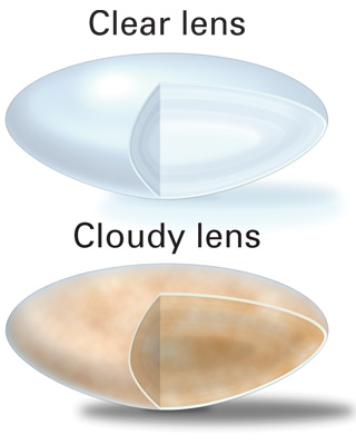 clear lens/cloudy lens